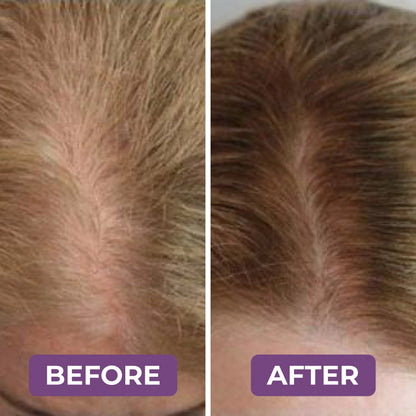 Milvora FolliForce Pro™ | HaarGroei Serum Voor Dikker & Voller Haar